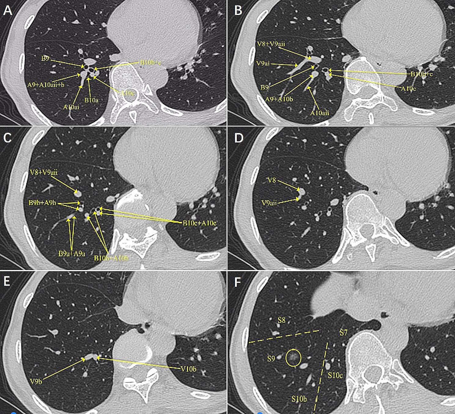 A combined subsegmentectomy of right S9 + 10b with single direction thoracoscopic surgery