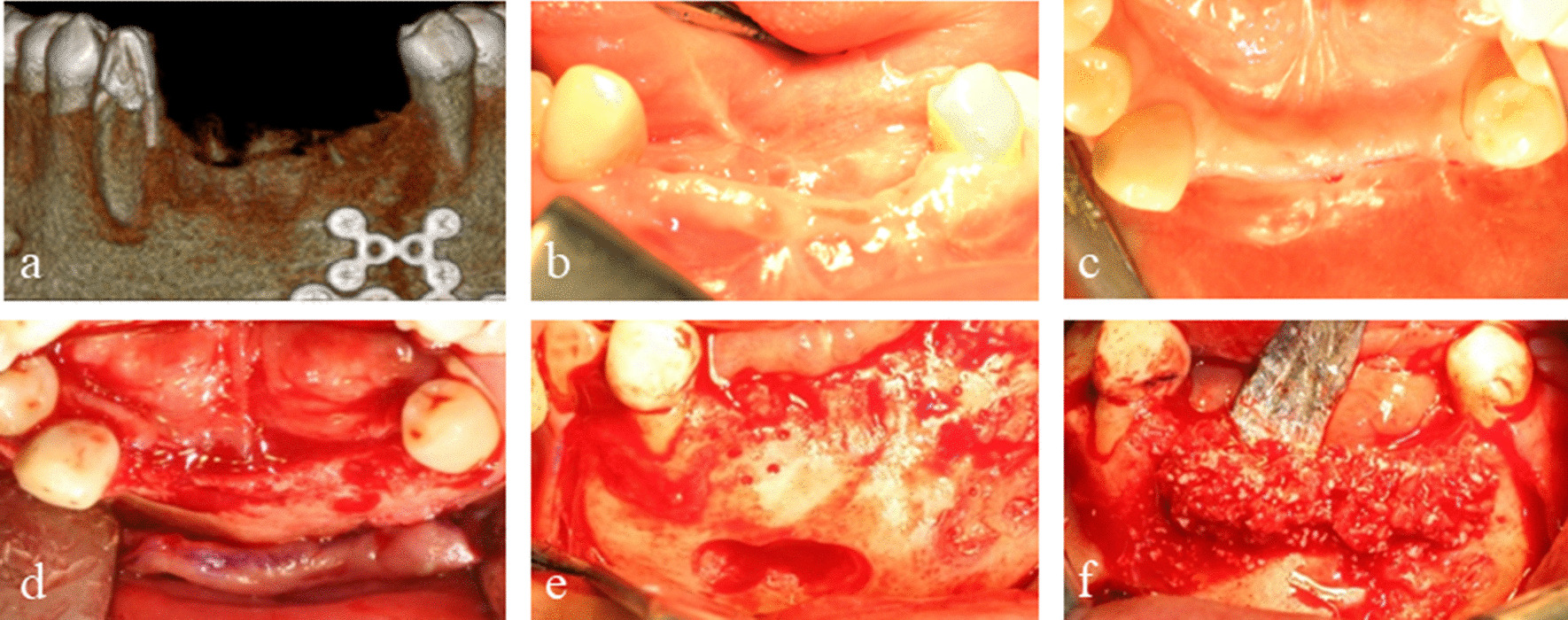 Semi-customized three-dimensional ultra-fine titanium meshes in guided bone regeneration for implant therapy in severe alveolar bone defect: a case report