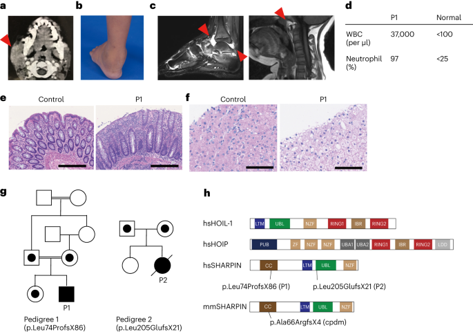 Biallelic human SHARPIN loss of function induces autoinflammation and immunodeficiency