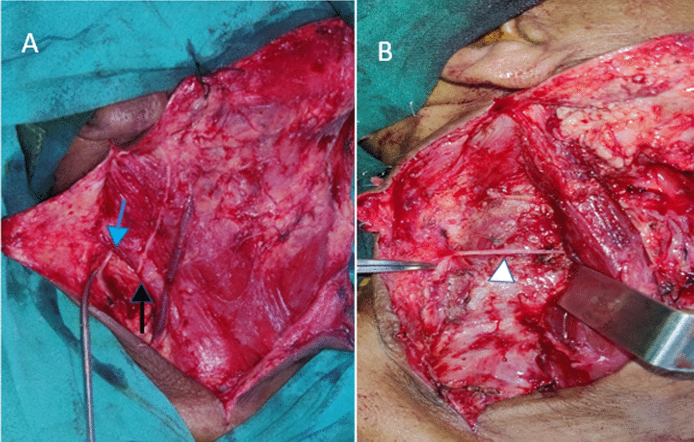 Shoulder Dysfunction and Quality of Life Following Modified Radical and Selective Neck Dissection: A Prospective Comparative Study