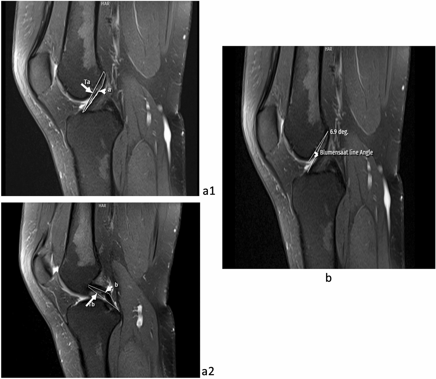 Three Morphological Risk Factors for Predicting Isolated Meniscal Bucket-handle Tear
