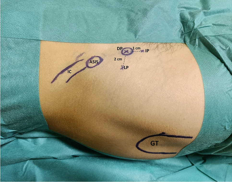 Endoscopic Assisted Percutaneous Fixation of Anterior Inferior Iliac Spine Avulsion Fracture, Surgical Technique