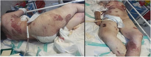 NSAID (nonsteroidal anti-inflammatory drugs) Induced Stevens Johnson Syndrome in a 50-year-old woman: A case study