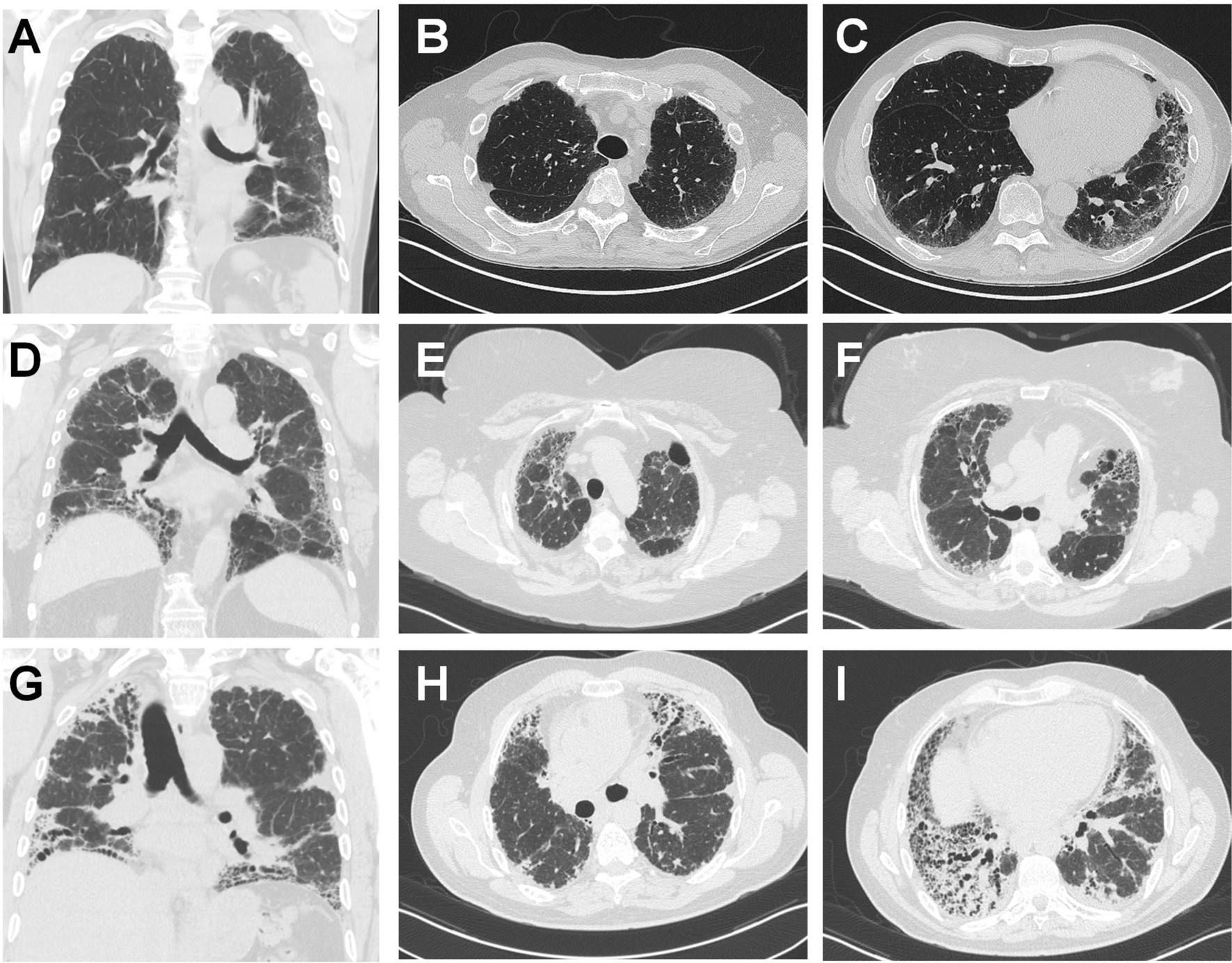 Diagnosis and Management of Pulmonary Manifestations of Telomere Biology Disorders