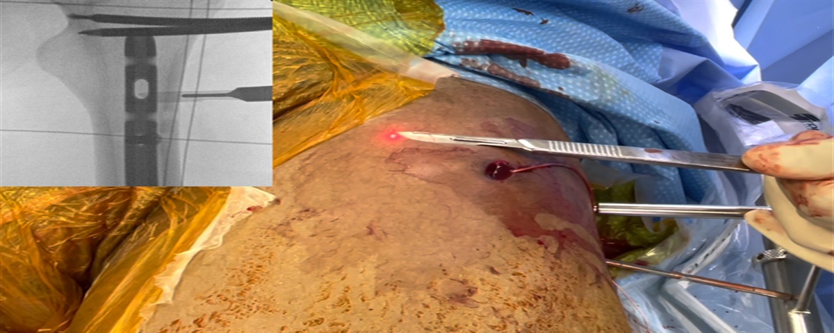 Perfect Circle Technique With C-arm Laser Augmentation