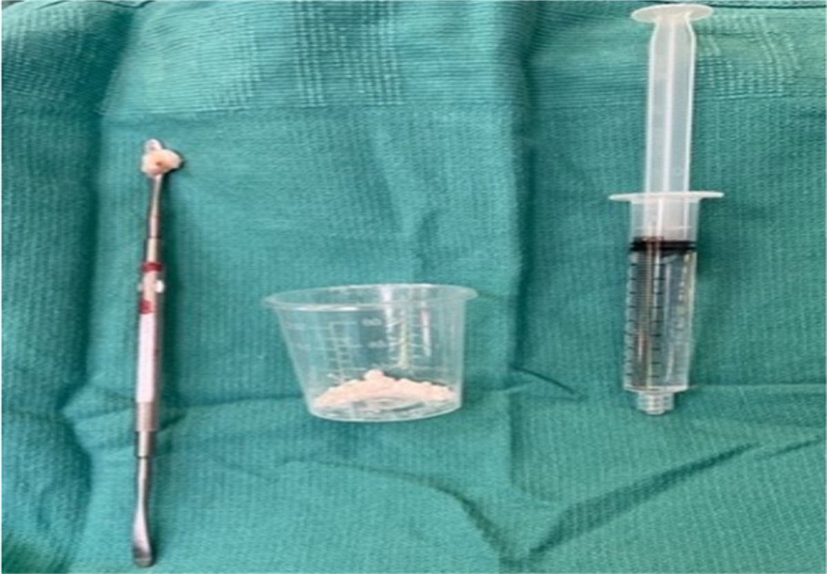 Vancomycin Three Ways: Multimodal Utilization of Intraoperative Antibiosis in Complex Foot and Ankle Infection