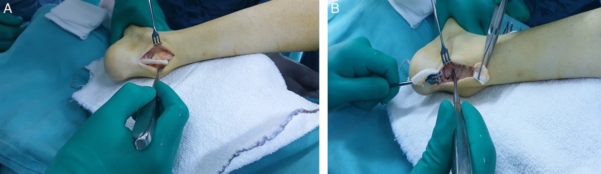 Combined Calcaneal Osteotomy and Achilles Tendon Lengthening in the Treatment of Rigid Heel Varus Deformity: A Novel Approach