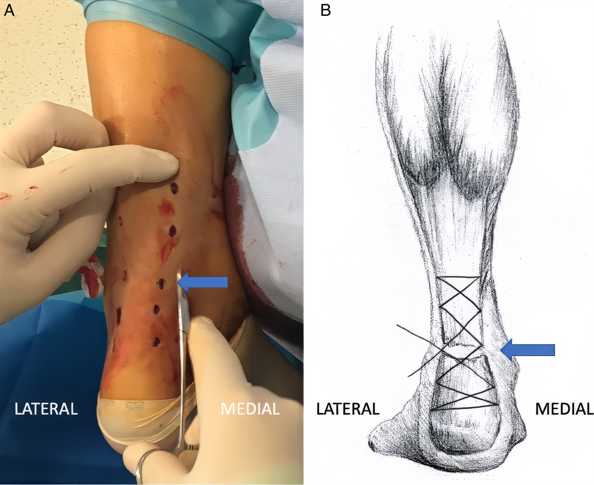 Ultrasound-guided Percutaneous Achilles Tendon Repair