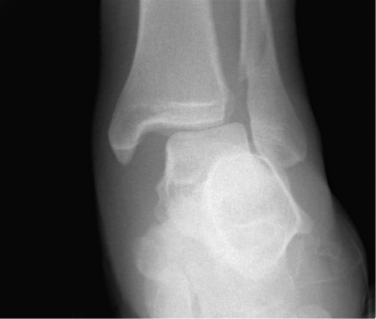 A Novel All-Inside Knotless Arthroscopic Deltoid Ligament Repair