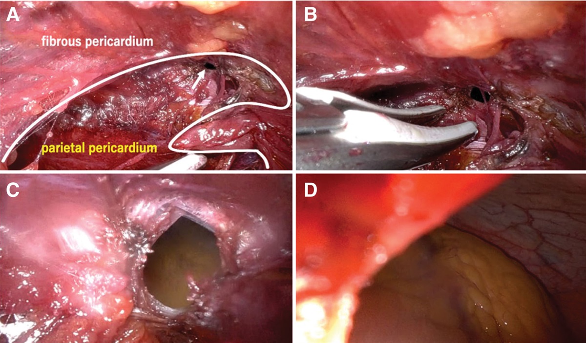 Cardiac Tamponade Caused By Carbon Dioxide Insufflation During Robot-Assisted Thoracic Surgery: A Case Report