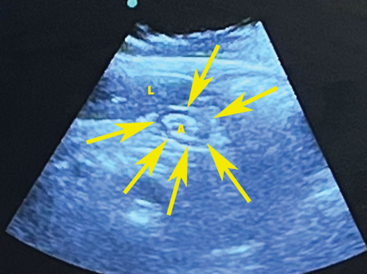 Point-of-Care Ultrasound Aids in the Management of Patient Taking Semaglutide Before Surgery: A Case Report