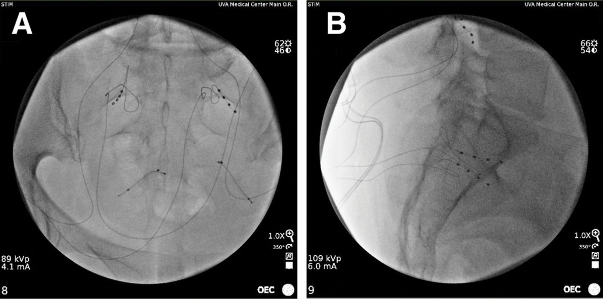 New-Onset Tinnitus After Dorsal Root Ganglion Stimulator Implantation: A Case Report
