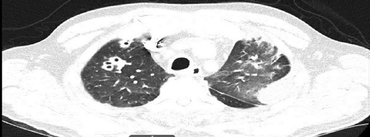 A Propitious Underlying Diagnosis for a Rare Figurate Skin Rash in a 56-Year-Old Man