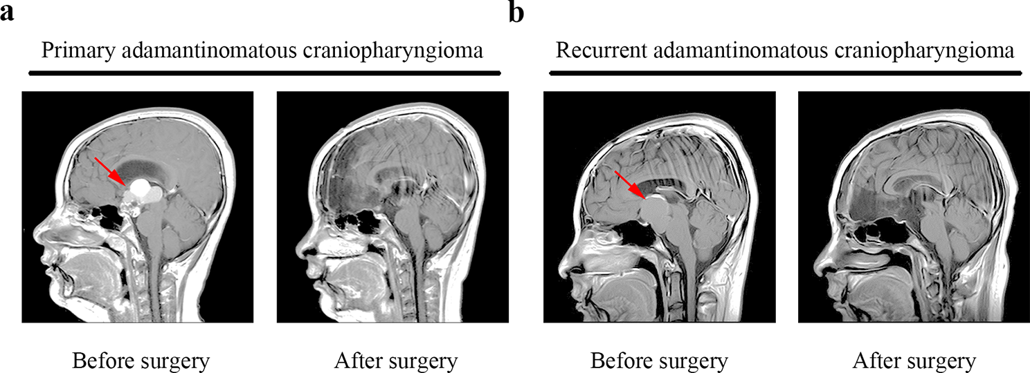 Proteomics study of primary and recurrent adamantinomatous craniopharyngiomas
