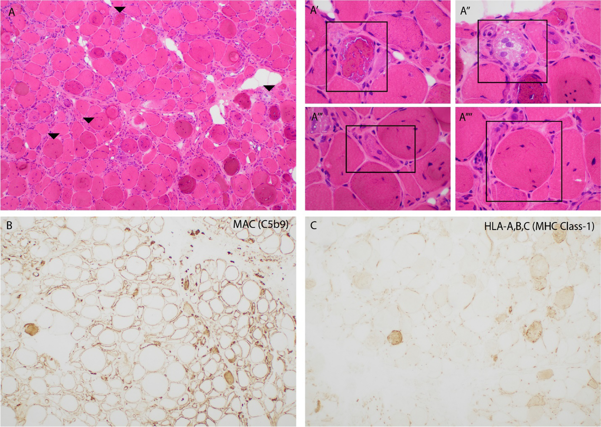 Immune-Mediated Necrotizing Myopathies: Current Landscape
