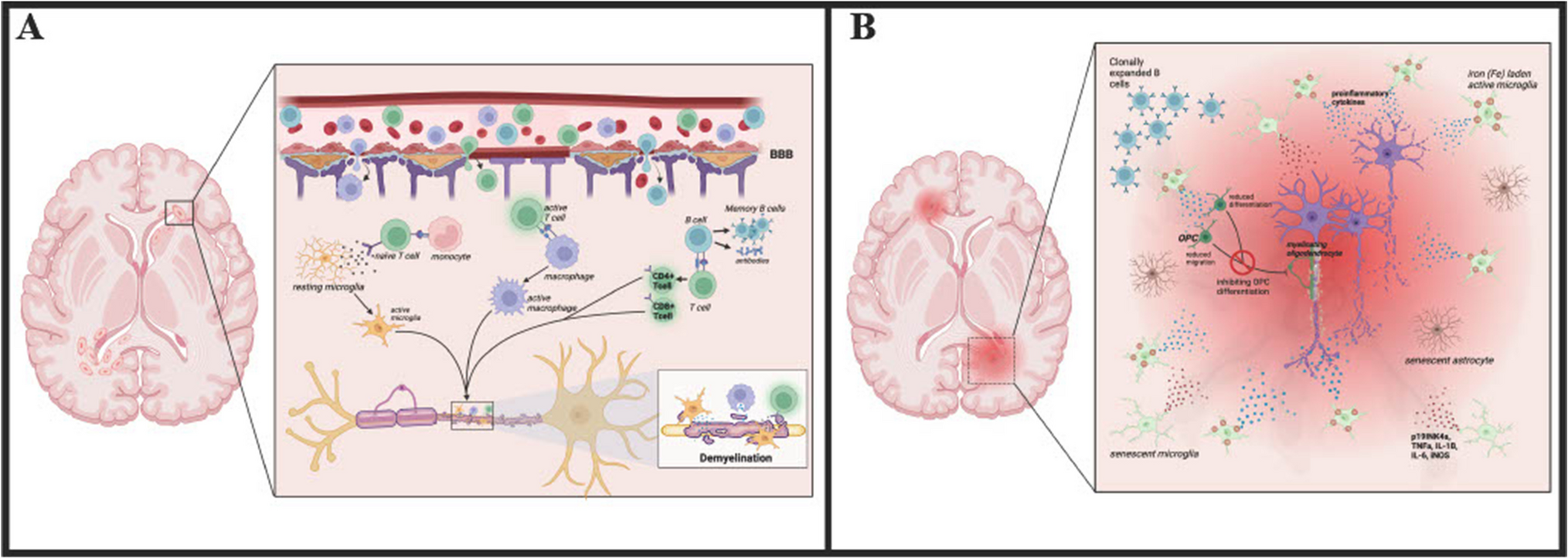 The Impact of Aging on Multiple Sclerosis