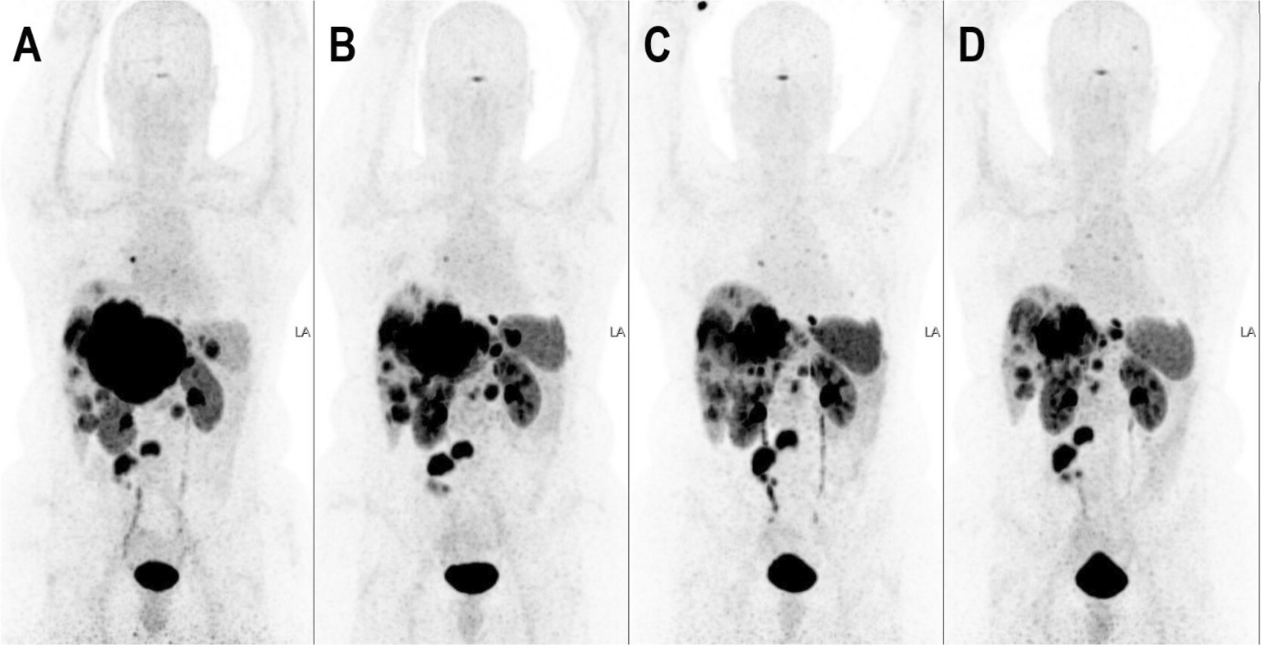 Advances in Radionuclide Therapies for Patients with Neuro-endocrine Tumors