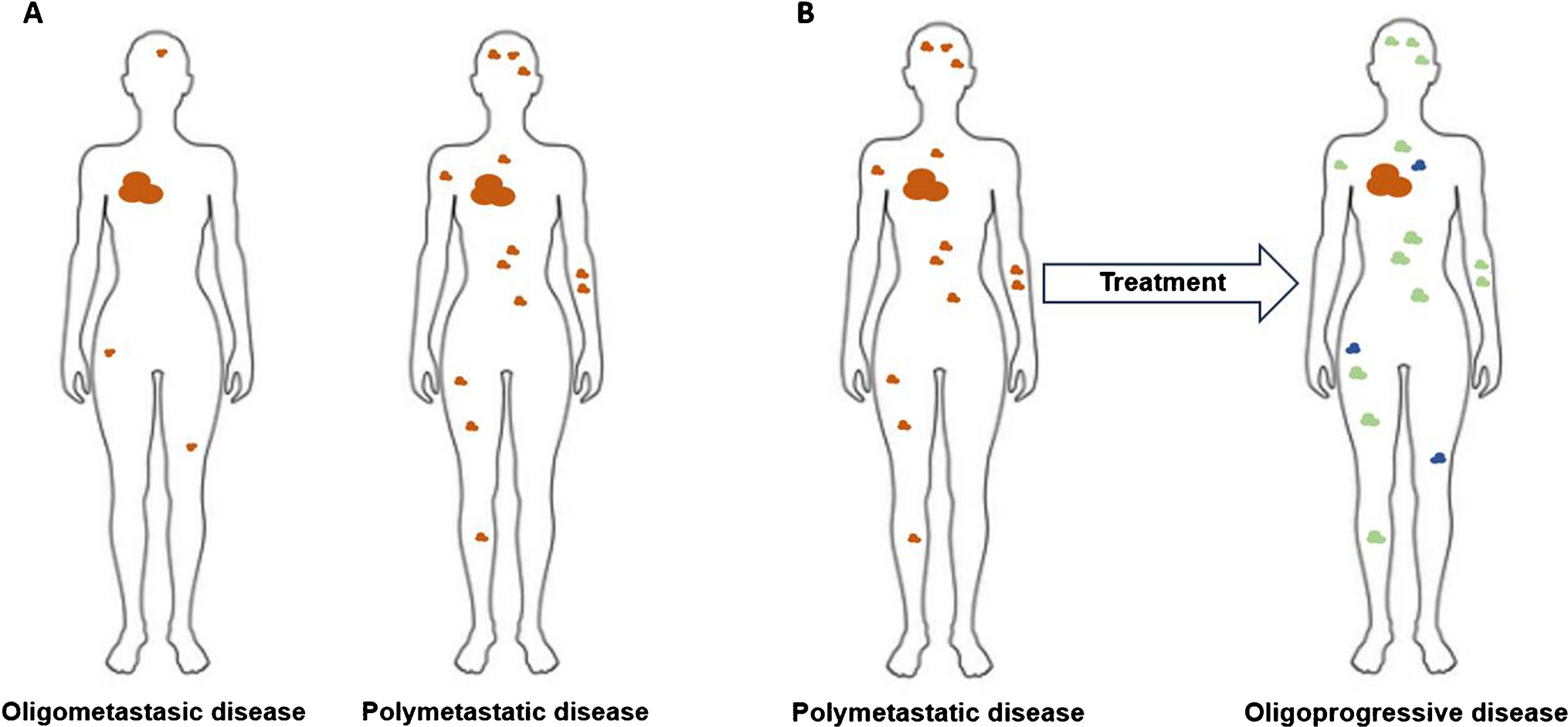 Navigating Breast Cancer Oligometastasis and Oligoprogression: Current Landscape and Future Directions