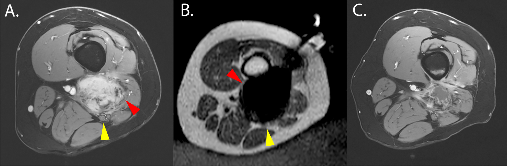 Update on Percutaneous Ablation for Sarcoma