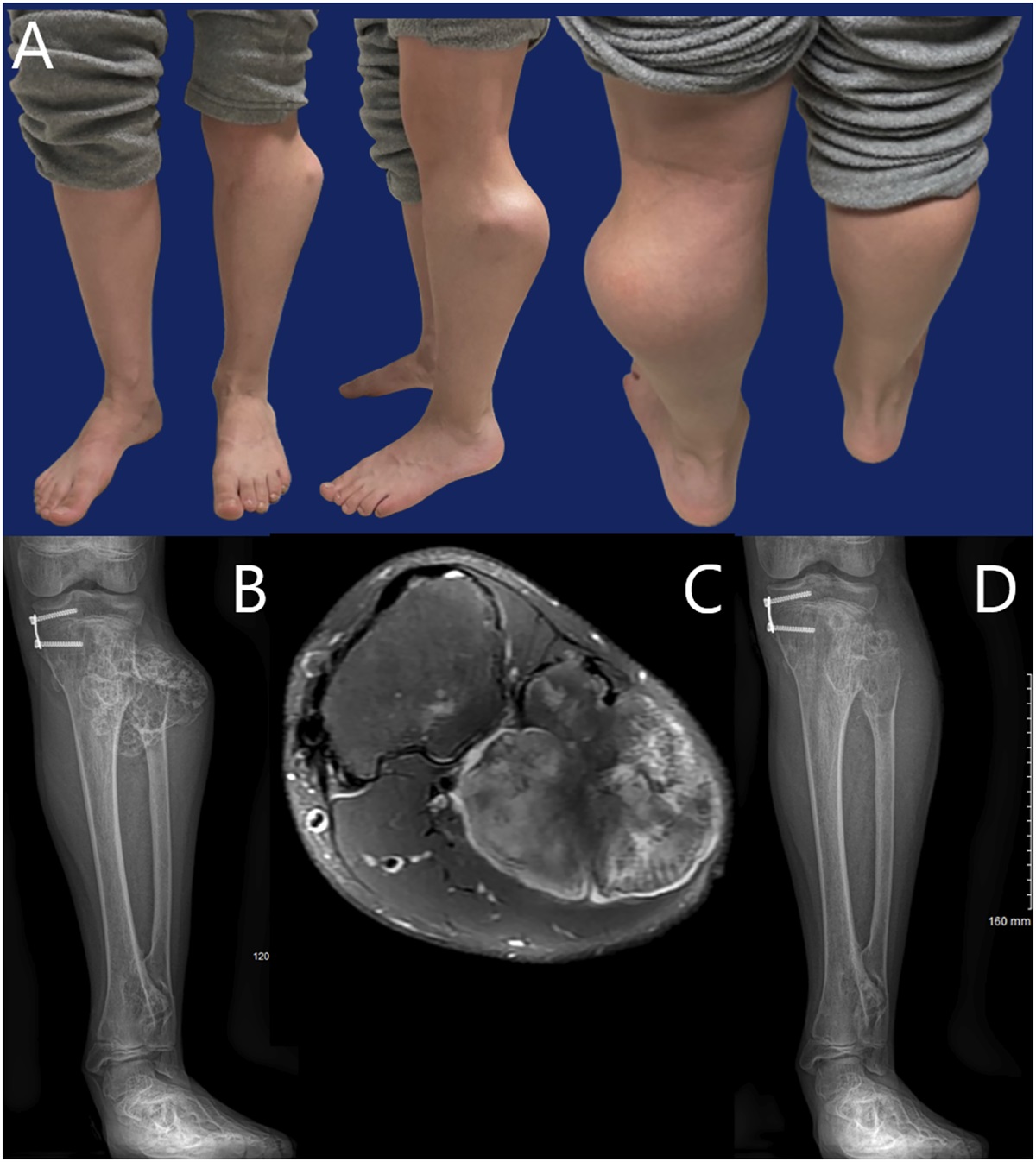 Peroneal Nerve Decompression in Patients with Multiple Hereditary Exostoses: Indications, Complications, and Recurrence