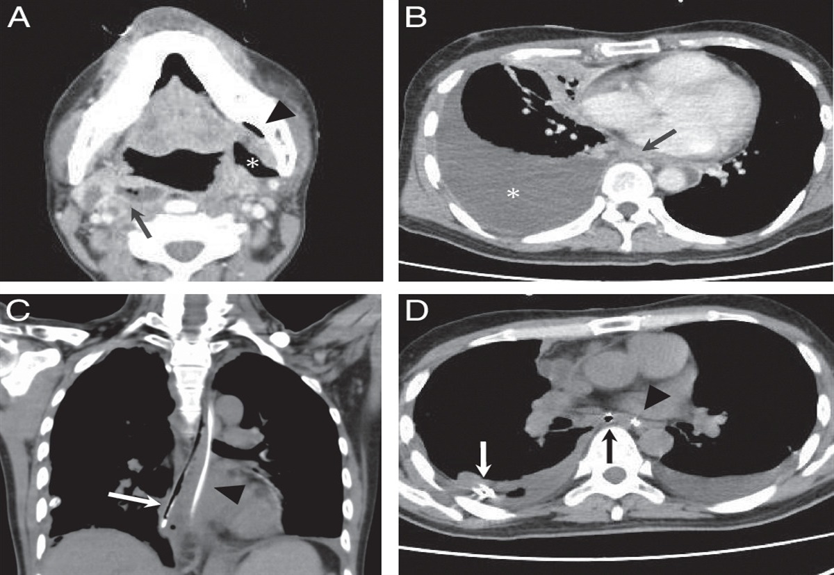 Exclusive Transcervical Drainage for Posterior Mediastinal Abscess Originating from a Mandibular Molar