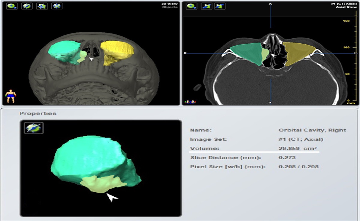 Prediction of Permanent Enophthalmos Using 3-Dimensional Integral Model in Blowout Fractures