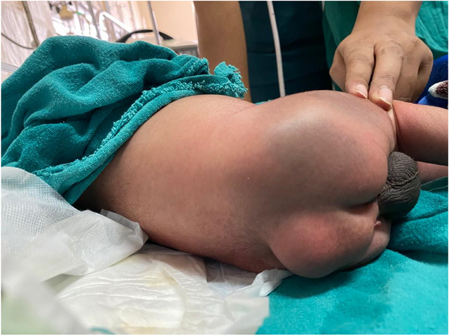 Anesthetic management of diphallia with anorectal malformation posted for colostomy: a rare association