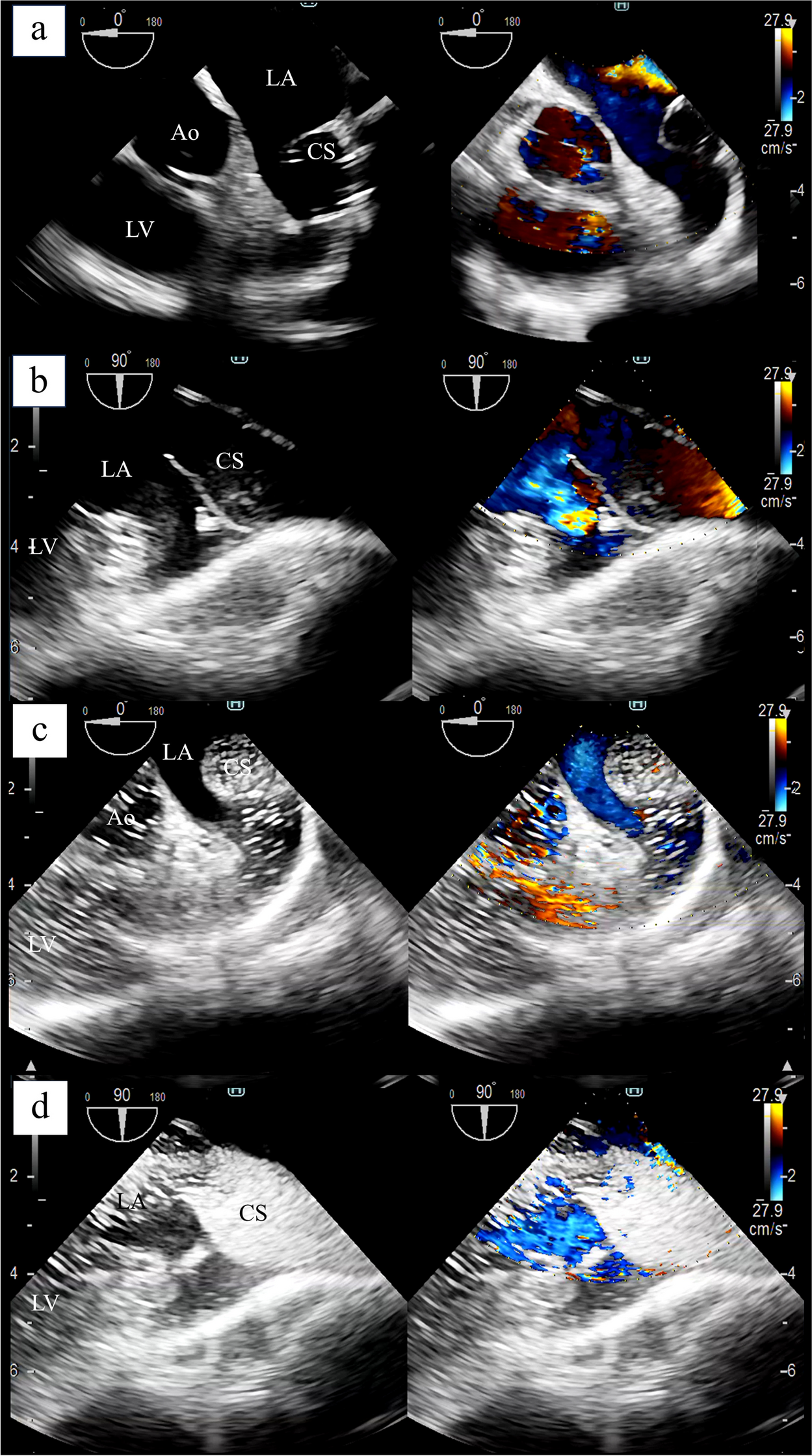 Agitated saline test as a simple but reliable method of intraoperative diagnosis and evaluation of unroofed coronary sinus