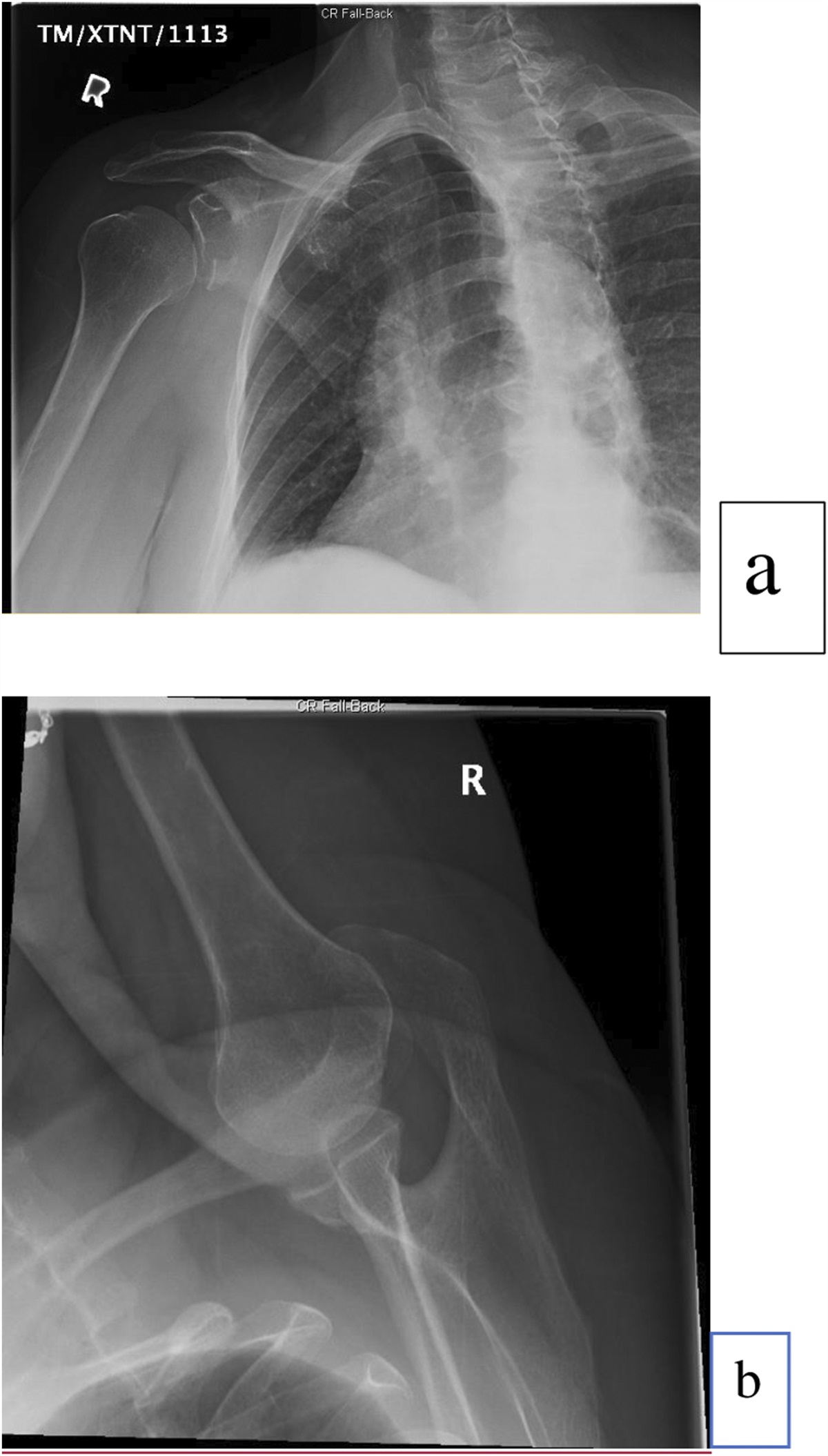Bony Bankart Lesion: Diagnosis, Management, and Outcomes