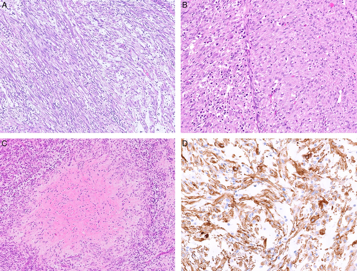 The “Other” Uterine Mesenchymal Neoplasms: Recent Developments and Emerging Entities