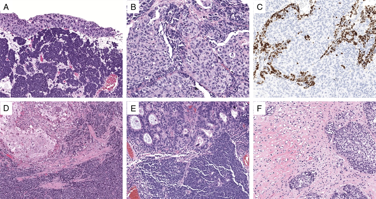 Updates on Urinary Bladder Tumors With Neuroendocrine Features