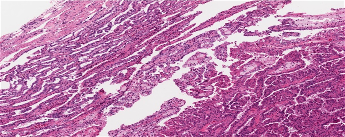 Papillary Renal Cell Carcinoma: Evolving Classification by Combined Morphologic and Molecular Means