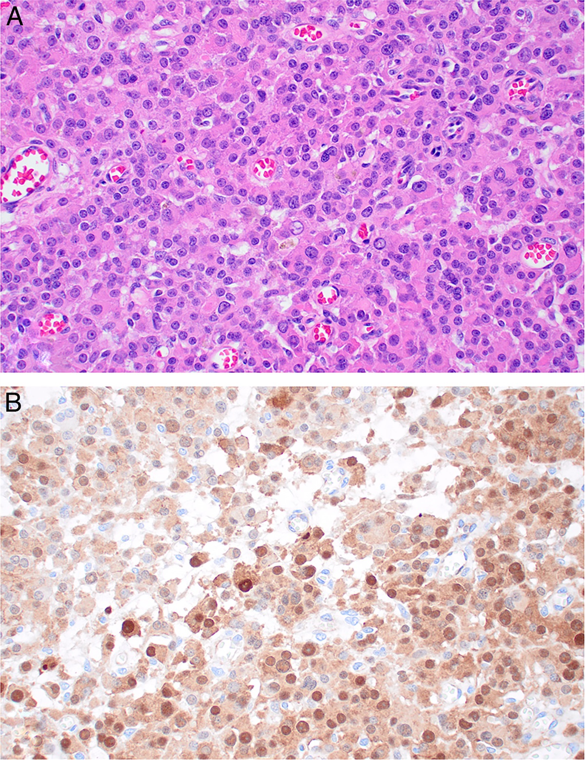 Contemporary Updates on Sex Cord–stromal Tumors of the Testis