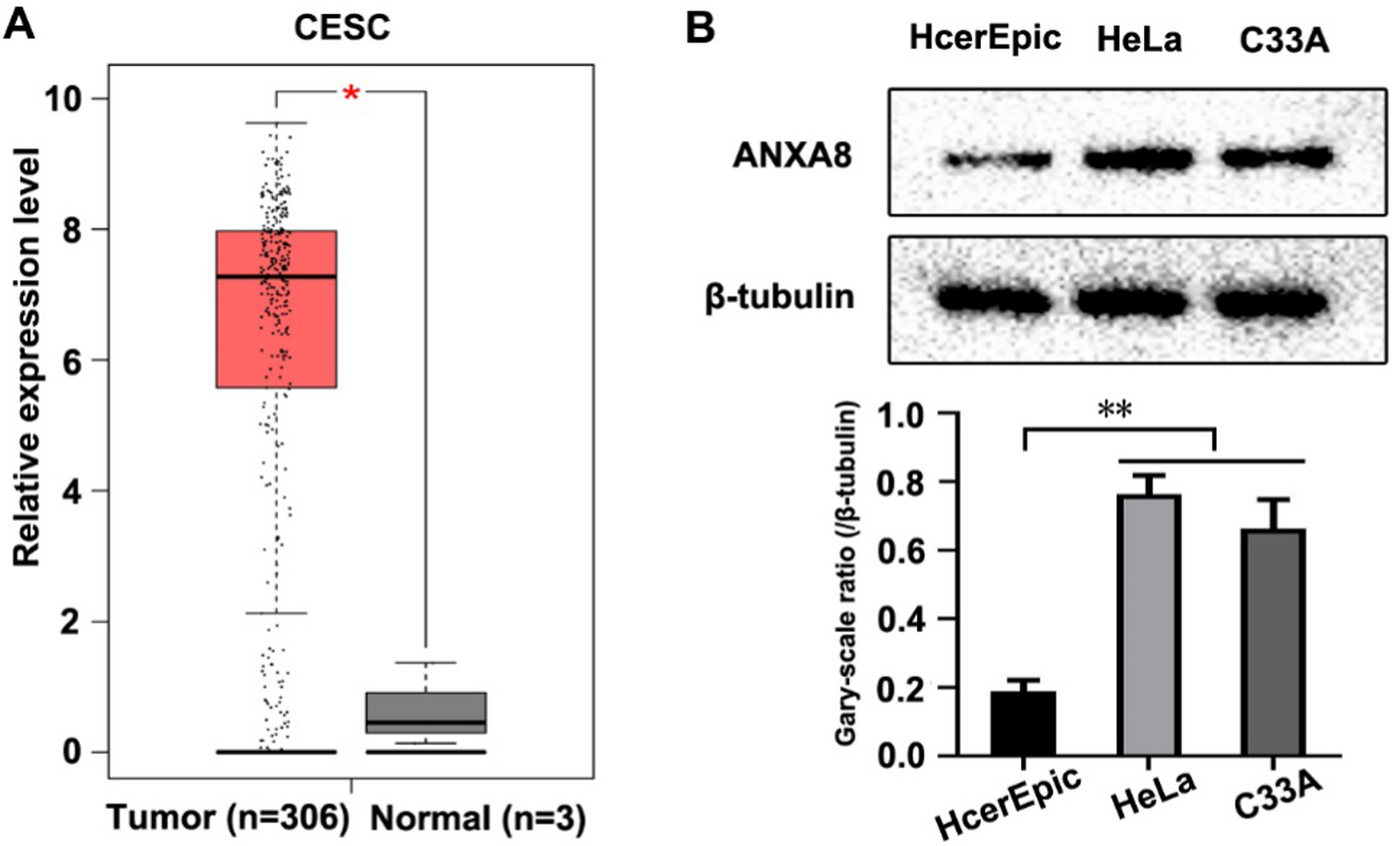 The effect of TFAP2A/ANXA8 axis on ferroptosis of cervical squamous cell carcinoma (CESC) in vitro