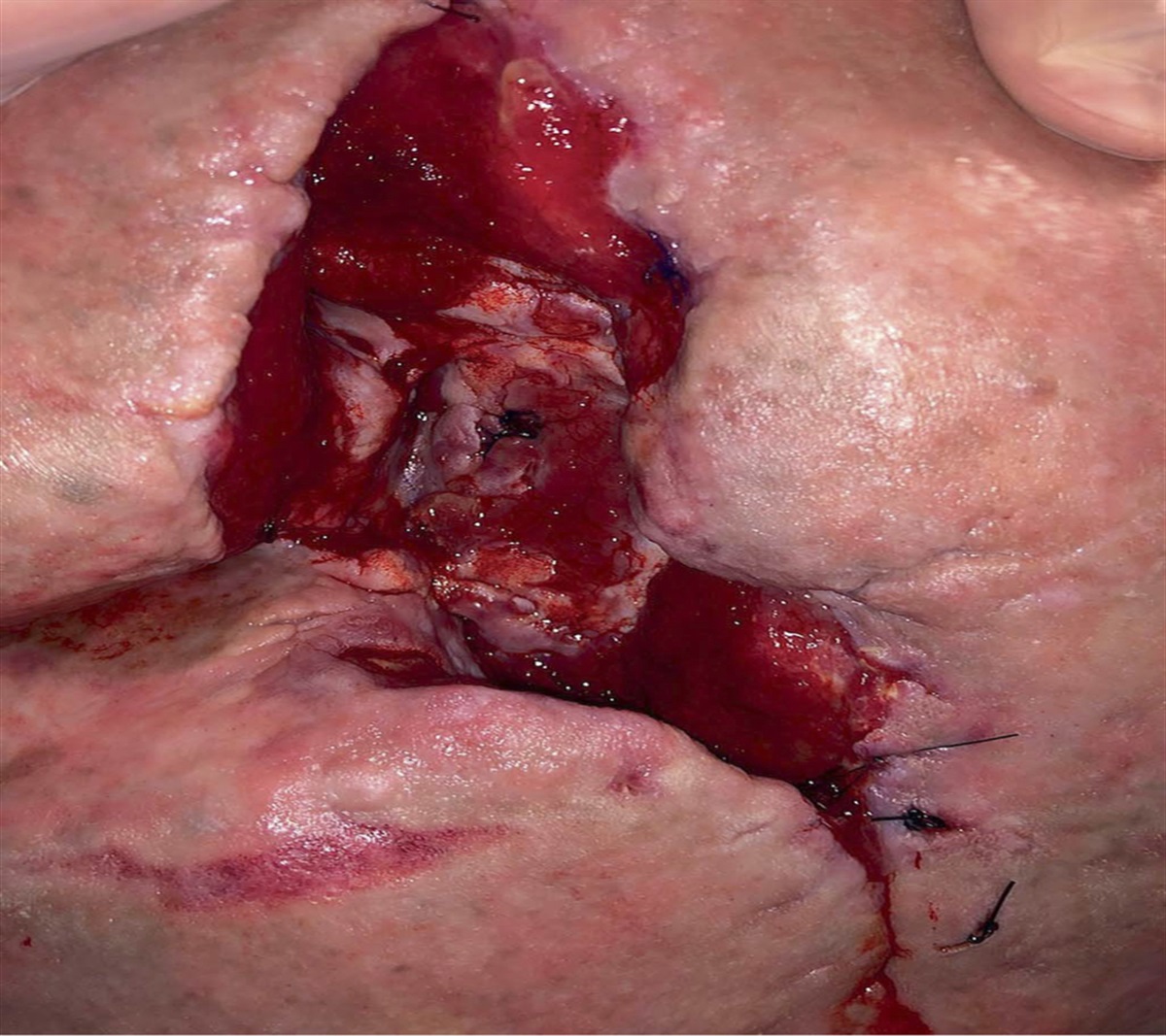 Bacterial Contamination Control with Sodium Hypochlorite and Jet Lavage Irrigation in a Severe Stage 4 Pelvic Pressure Injury: A Case Report