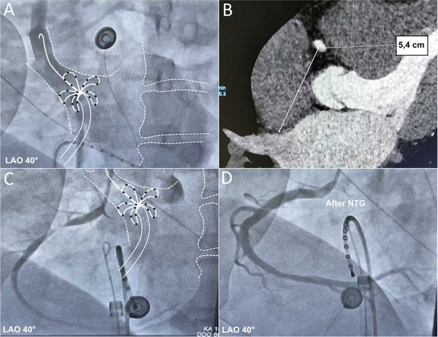 Severe ST-segment elevation and AV block during pulsed-field ablation due to vasospastic angina — a novel observation