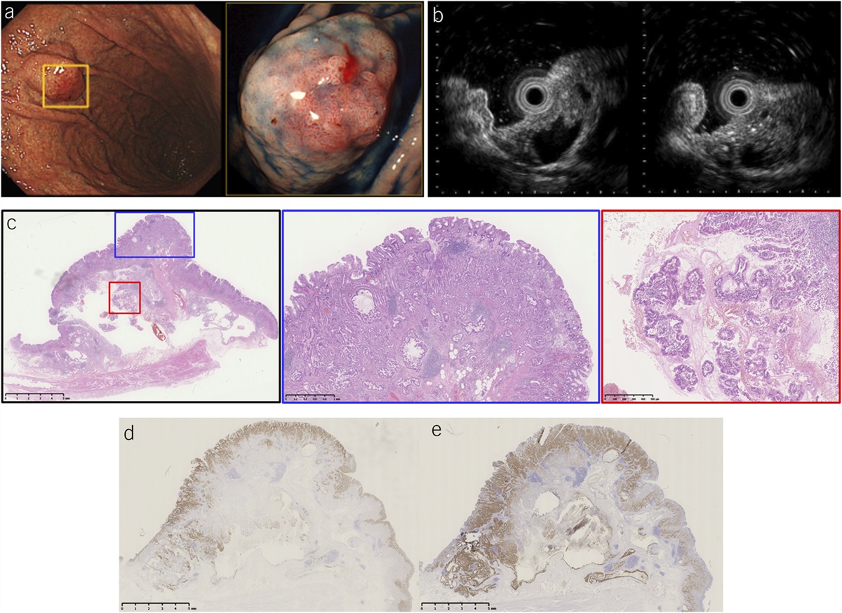 True, True and Unrelated? A Case of 2 Nearby Gastric Lesions