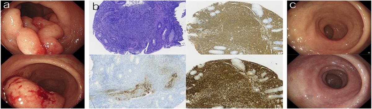 An Unusual Case of Rectal Follicular Lymphoma