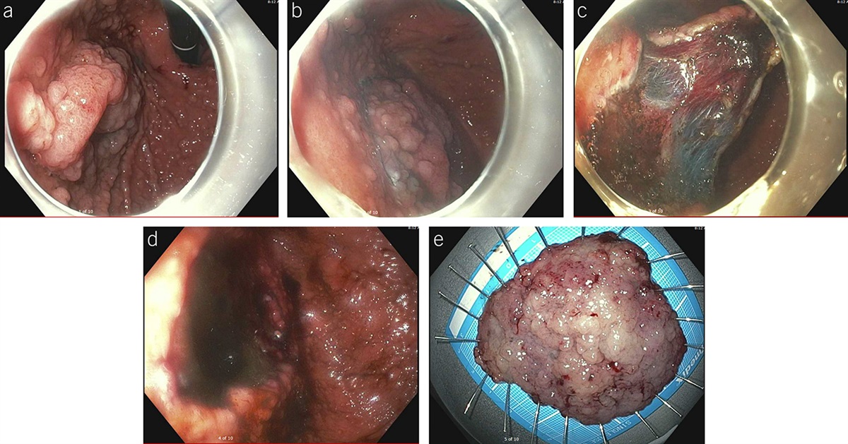 Endoscopic Submucosal Dissection of a Large Sessile Polyp in the Gastric Fundus