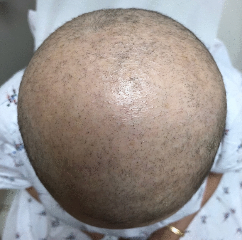 The Impact of Dermatologic Adverse Events on the Quality of Life of Oncology Patients: A Review of the Literature