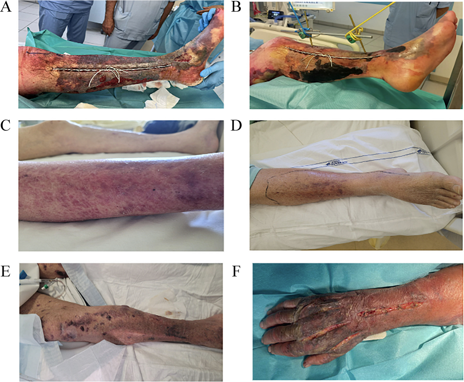 Non-cholera Vibrio spp. invasive infections in the summer following May 2023 flood disaster in Romagna, Italy: a case series