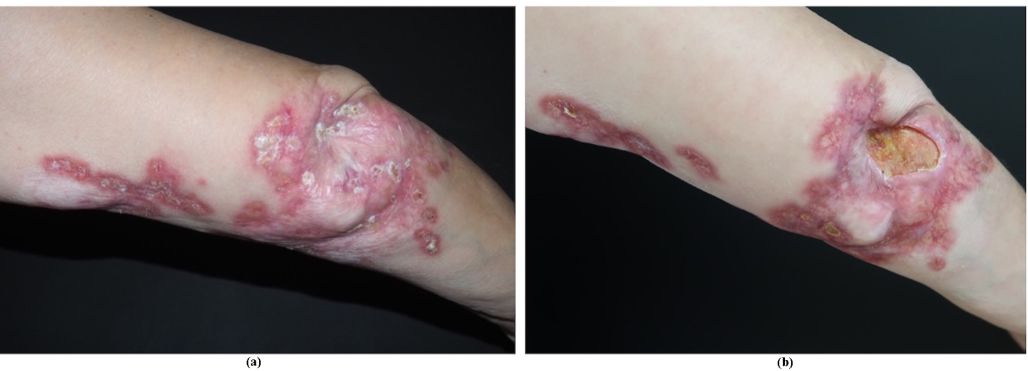 Rubella virus-associated cutaneous granulomatous disease in an immunocompetent woman