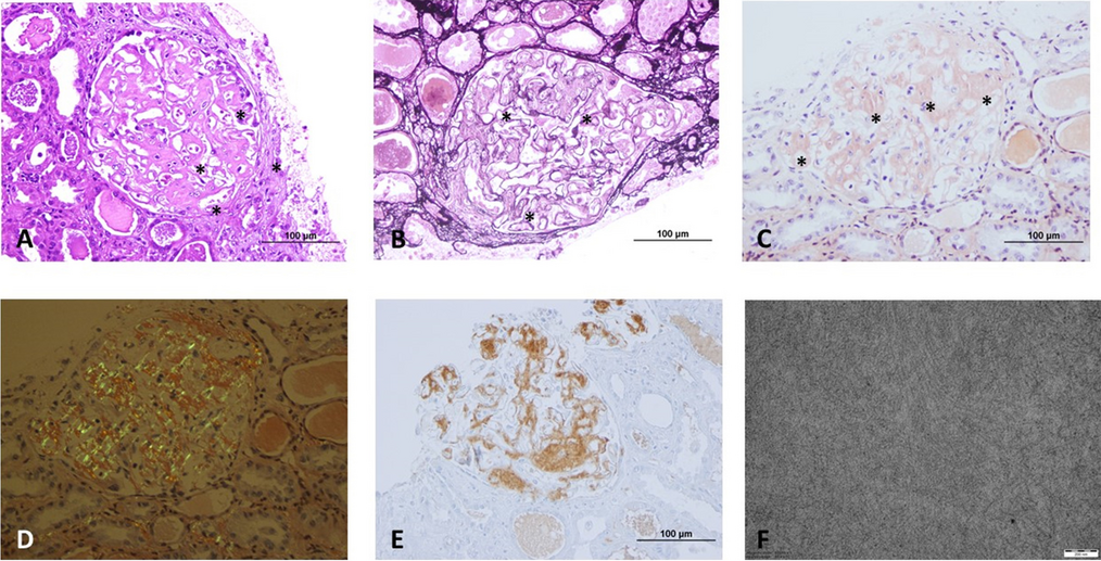 AA Amyloidosis: A Contemporary View