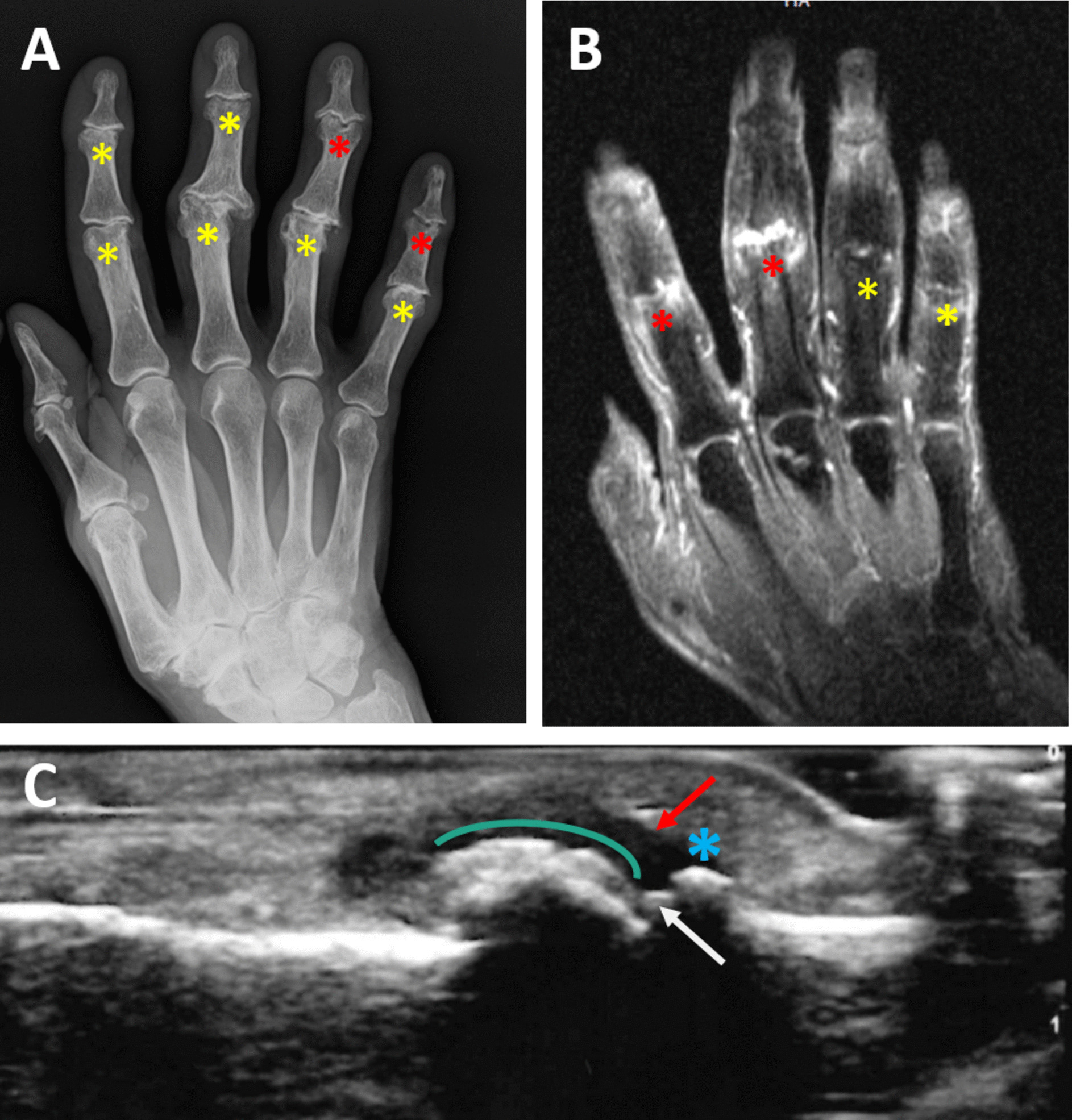 Erosive Hand Osteoarthritis: Recent Advances and Future Treatments