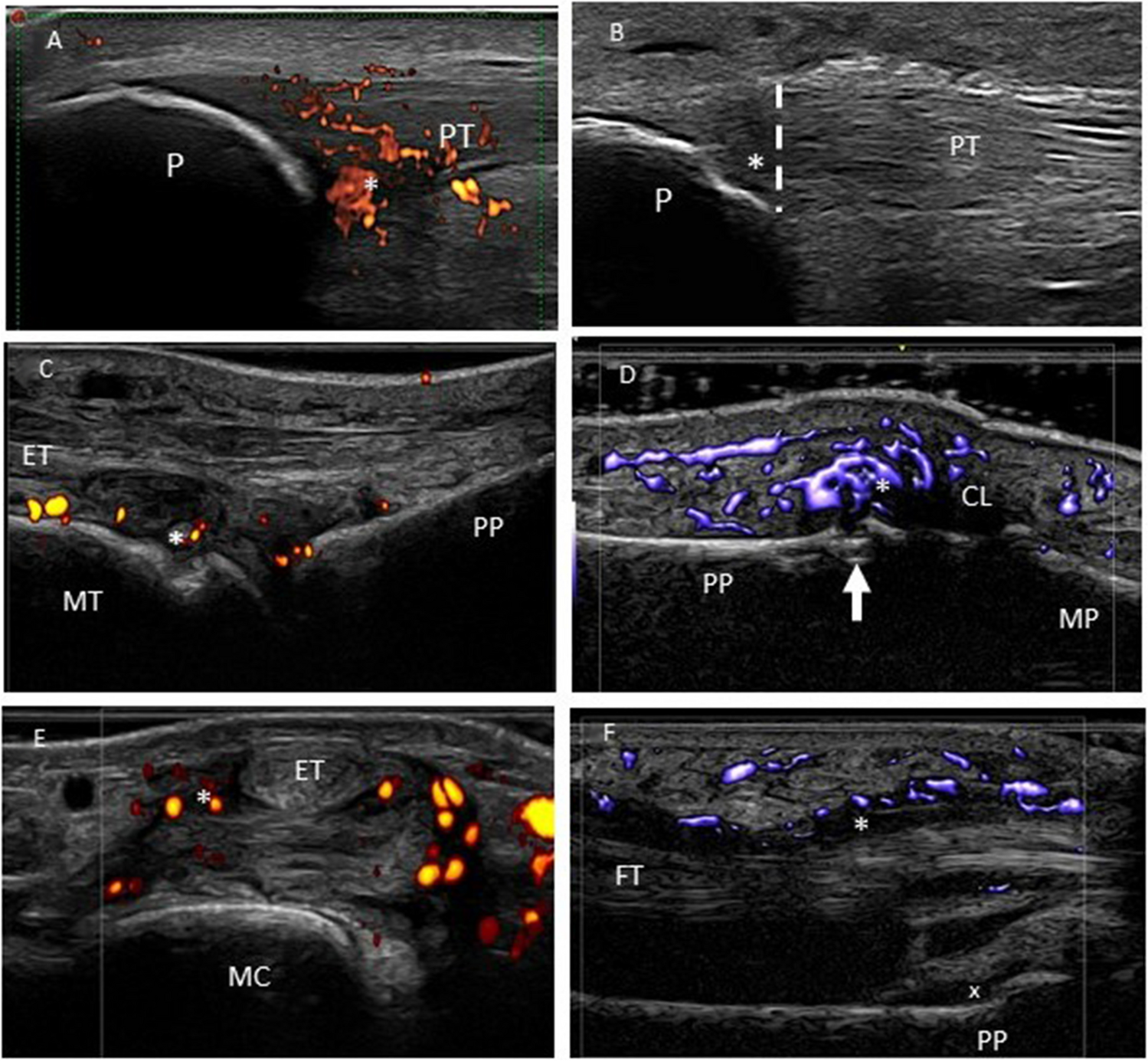 From Psoriasis to Psoriatic Arthritis: Ultrasound Insights Connecting Psoriasis with Subclinical Musculoskeletal Inflammation and the Path to Psoriatic Arthritis