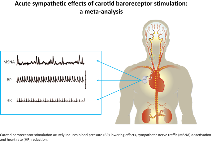 Effects of acute carotid baroreceptor stimulation on sympathetic nerve traffic in resistant and uncontrolled hypertension: a systematic review and meta-analysis