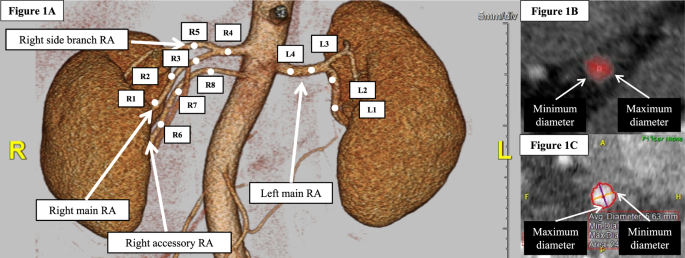 Underestimation of renal artery lumen diameter by computed tomography has consequences for the assessment of patient eligibility for renal denervation