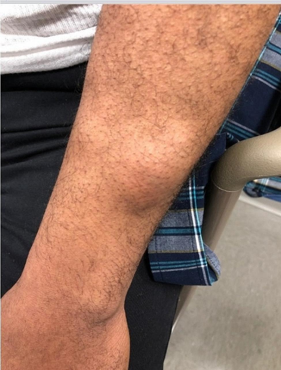 Angiolipoma associated with antiretroviral switch therapy: a case report