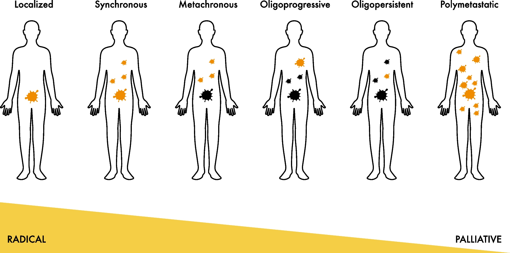 Role of Metastasis-Directed Therapy in Genitourinary Cancers