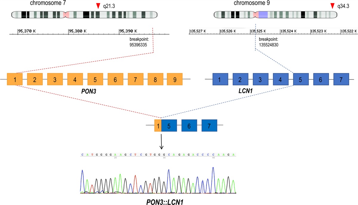 PON3::LCN1 and HTN3::MSANTD3 Gene Fusions With NR4A3/NR4A2 Expression in Salivary Acinic Cell Carcinoma